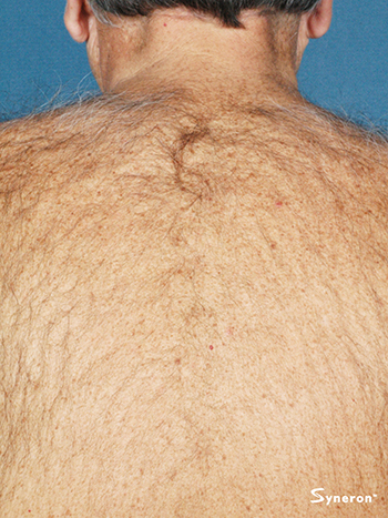 Before Back Hair Removal